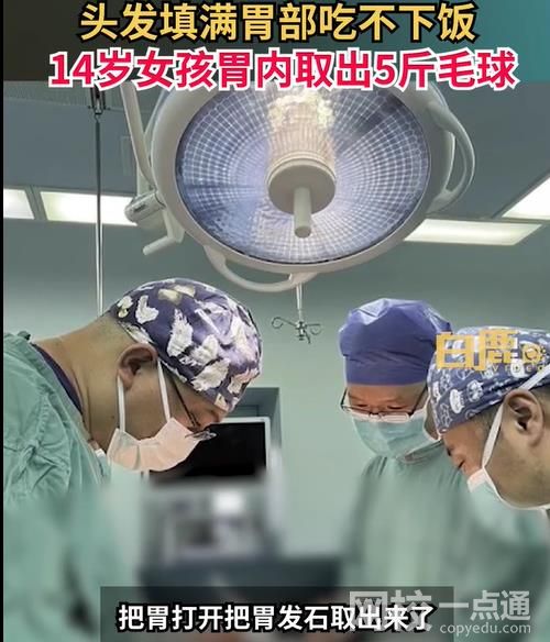 女孩吃頭發(fā)胃里取出5斤毛球 胃部已被“胃發(fā)石”填滿