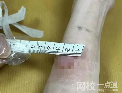 女子稱卷發棒爆炸致手臂二度燙傷 始料未及真相簡直太崩潰了