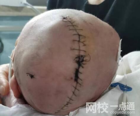 嬰兒出生后顱骨骨折 醫院回應:術中出現了取頭困難的情況