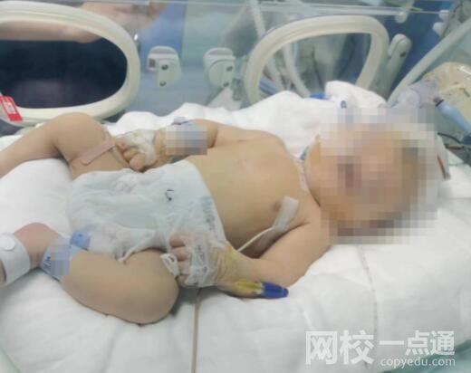 嬰兒出生后顱骨骨折 醫院回應:術中出現了取頭困難的情況