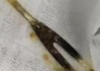 男子腹痛三月以為是腫瘤結(jié)果是叉子 到底是怎么進去的？