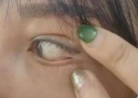 女子稱花3萬(wàn)整容 眼球眼角被縫一起 實(shí)在太悲劇了