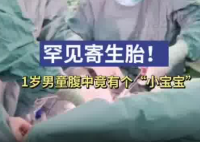 1歲男童腹中竟有個(gè)小寶寶 實(shí)在太罕見(jiàn)了