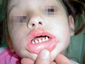 長哪吒同款鯊魚牙可能患有罕見病 究竟是什么樣的？