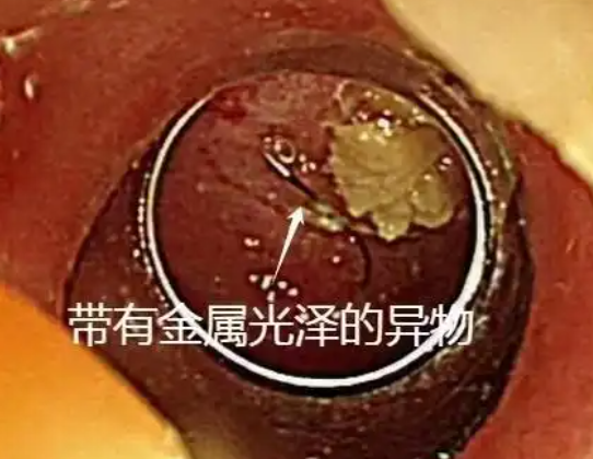 老人突發(fā)高燒拍胸片意外發(fā)現(xiàn)魚(yú)鉤 這也太恐怖了