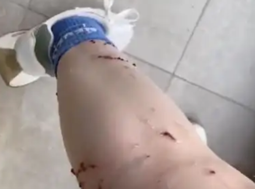 女子被寵物貓咬傷腿部潰爛 究竟是怎么回事？