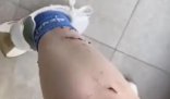 女子被寵物貓咬傷腿部潰爛 究竟是怎么回事？