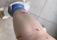 女子被寵物貓咬傷腿部潰爛 究竟是怎么回事？