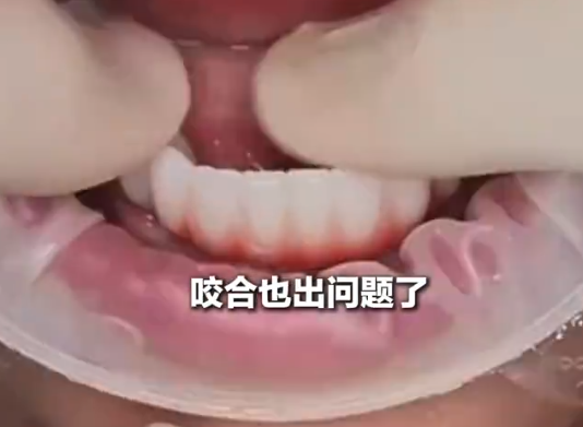 女子花6萬植12顆牙2年調試20多次 究竟是怎么回事？